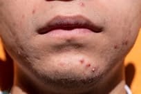Man face red bumps under the beard
