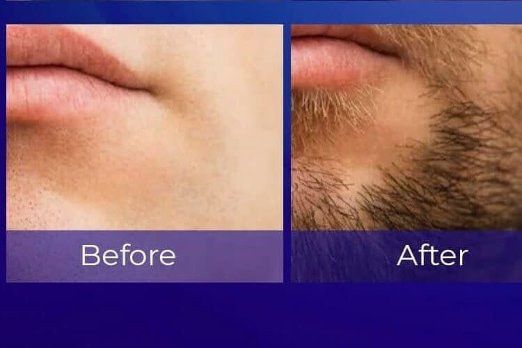 minoxidil for beard before and after
